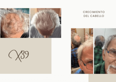 Antes y Después X39 | Crecimiento del Cabello