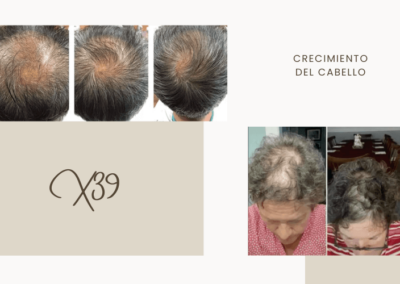 Antes y Después X39 | Crecimiento del Cabello